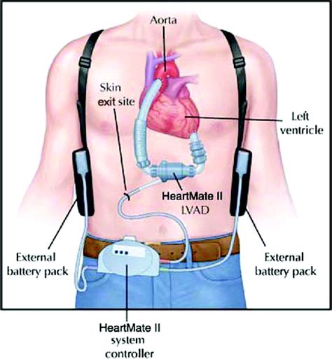 lv assist device|ventricular assist device vad.